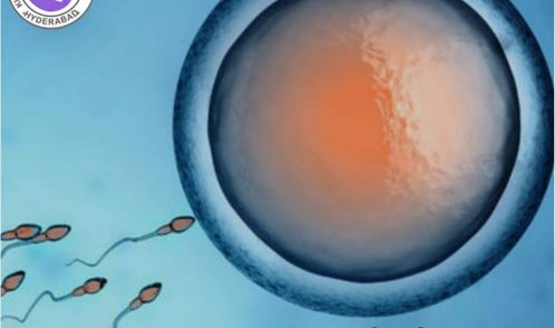 IUI treatment in hyderabad
