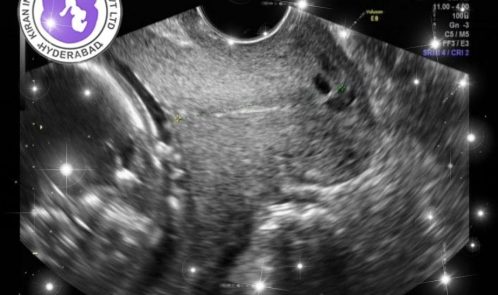 surrogacy hospital in hyderabad