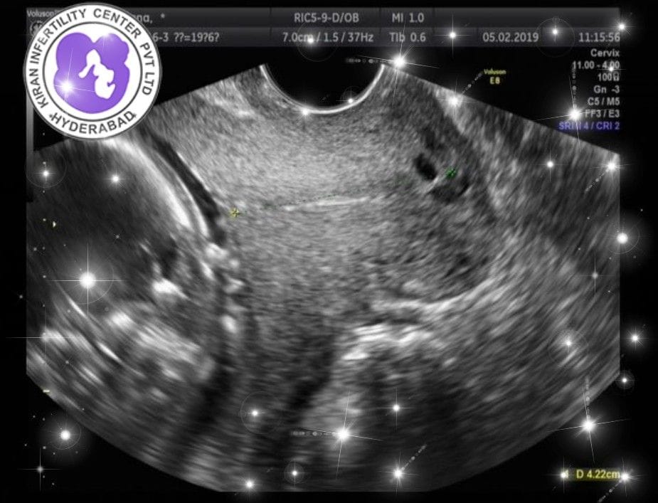 surrogacy hospital in hyderabad