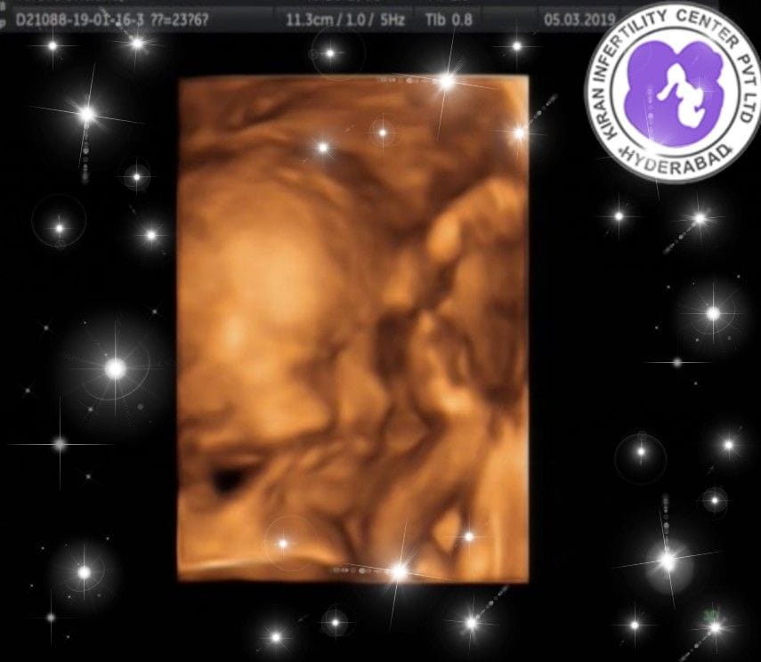 	 Surrogacy Treatment in Hyderabad