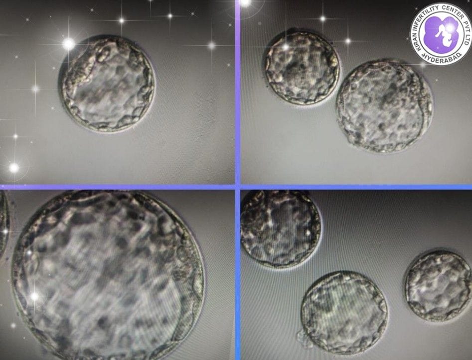 blastocyst_Treatment_in_Hyderabad