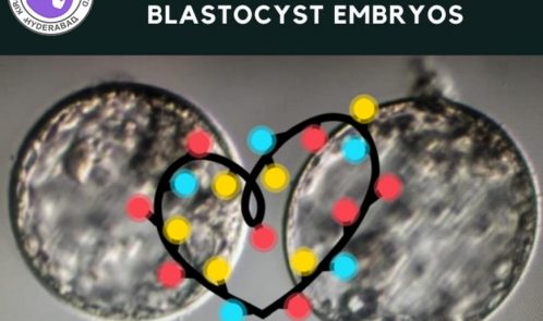 Successfully transferred Blastocyst embryos to one of our patients