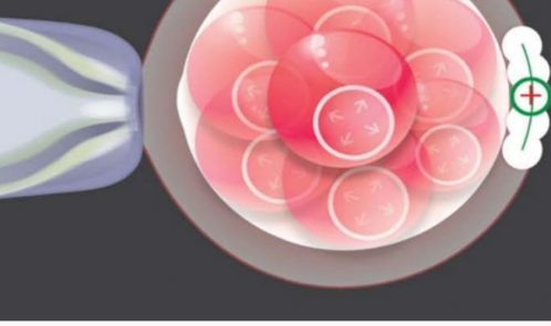 Importance of Assisted Hatching