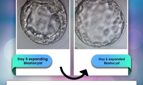transfer blastocyst