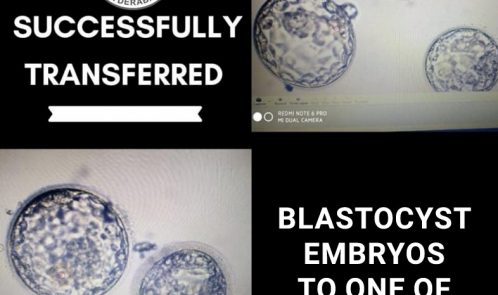 Successfully transferred Blastocyst embryos to one of our patients