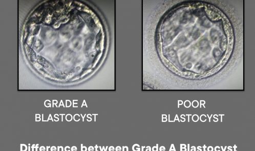 Difference between a Grade “A” Blastocyst and a poor quality Blastocyst