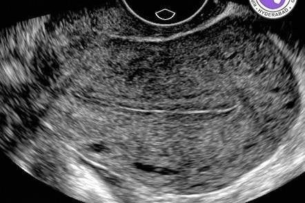 THIN ENDOMETRIUM- CAUSES AND TREATMENT