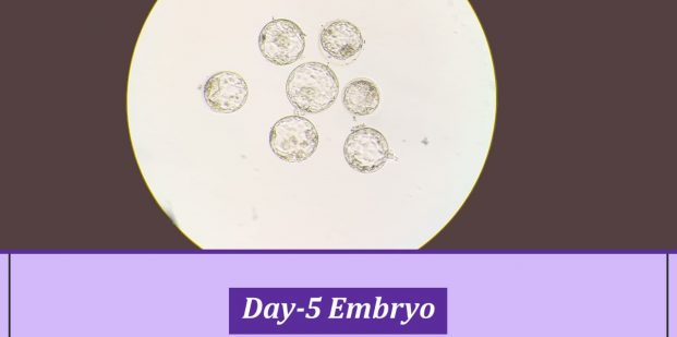Successfully transferred Day 5 embryos to one of our patients