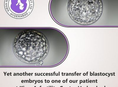 Yet another successful transfer of blastocyst embryos to one of our patient at Kiran Infertility Center Hyderabad