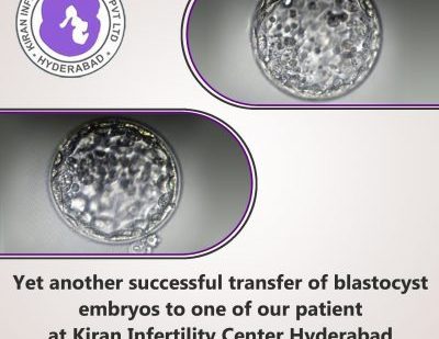 Yet another successful transfer of blastocyst embryos to one of our patient at Kiran Infertility Center Hyderabad