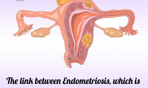 endometriosis