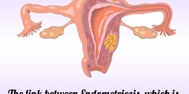 endometriosis