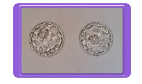 These 2 precious embryos are from a patient struggling with infertility for more than 12 years.
