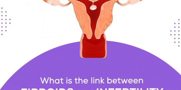 What is the link between fibroids and infertility in women of fertility age?