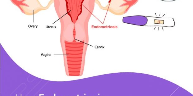 How Endometriosis and fertility are connected?