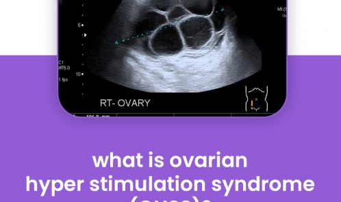 What is ovarian hyper stimulation syndrome (OHSS)?