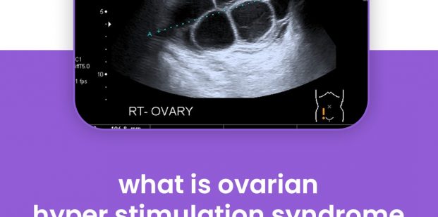 What is ovarian hyper stimulation syndrome (OHSS)?