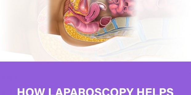 How laparoscopy helps in treating infertility