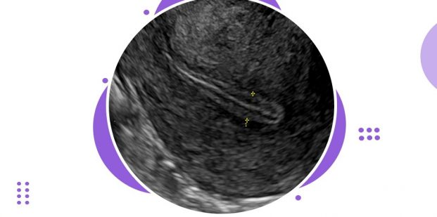 How the thickness of the endometrium is measured?