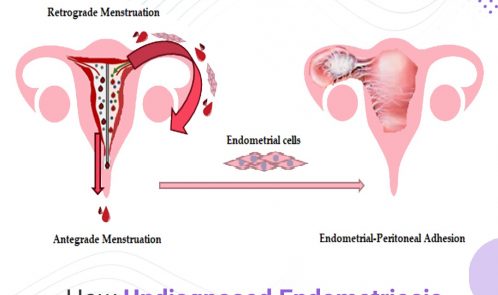 How undiagnosed endometriosis compromises fertility treatment