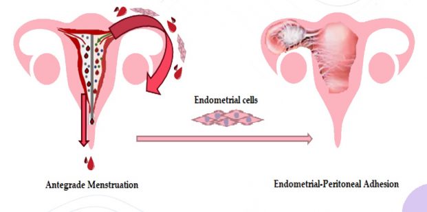 How undiagnosed endometriosis compromises fertility treatment