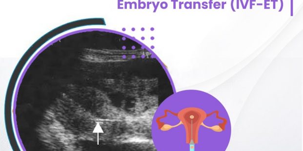 The role of ultrasonography in in-vitro fertilization and embryo transfer (IVF-ET)