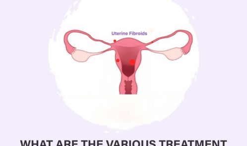 What are the various treatment options for fibroids