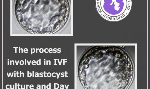 The process involved in IVF with blastocyst culture and Day 5 transfer