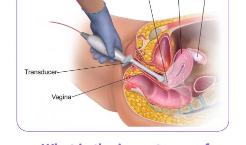 What is the importance of Transvaginal ultrasound or TVS?