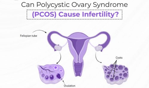 Can Polycystic Ovary Syndrome (PCOS) Cause Infertility