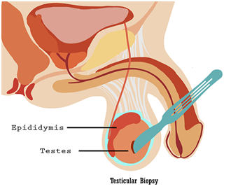testicular biopsy in hyderabad