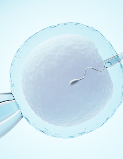 ICSI procedure showing direct sperm injection into egg for fertilization